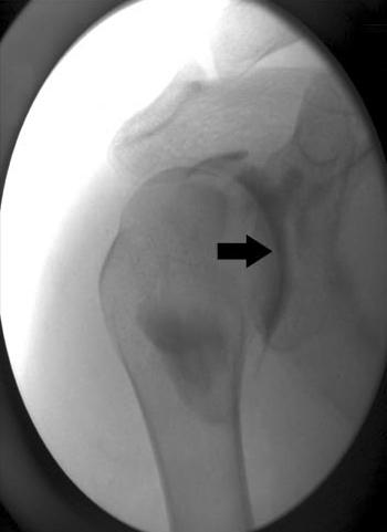 direction toward the inferior space of biceps tendon. Fig. 5. Glenohumeral arthrogram verifies the intraarticular distribution of the contrast material. Table 1.