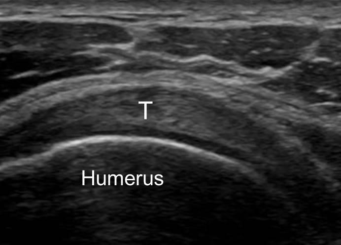 The hyperechogenic thickened tendon sheath