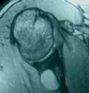 Spinoglenoid notch cyst Arthroscopic labrum