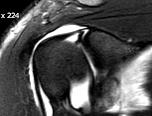 compensatory hypertrophy of teres minor 관절와순주위낭종