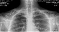adult : more than two-thirds of clavicle fractures