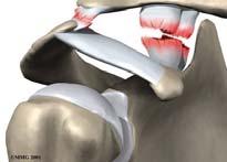 5 to 2cm 견봉쇄골관절손상 Acromioclavicular Joint Injury