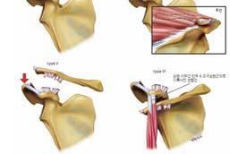 brace) Immobilization 1~6wk Surgical Tx 견봉쇄골관절 퇴행성관절염,