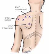 승모근부위통증 Trigger point ( 통증유발점 ) Trapezius muscle ( 승모근 )