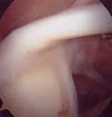 그밖의원인 상완이두건 LHBT (Long Head of Biceps Tendon) From