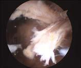 insertion) Tear of long head of biceps Rotator cuff