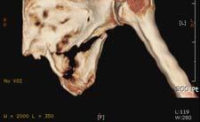 shoulder Calcification in triceps tendon insertion By traction