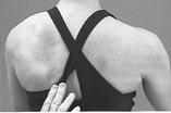 Type 1 prominence of inferior medial scapular angle