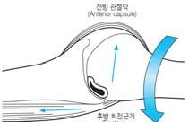 rotation 충돌부위관절와후 - 상방면 vs 회전근개하방면 내적충돌 Internal impingement Repeated