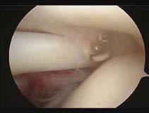 impingement repetitive hypertwisting of RC fiber fatigue & torsional