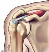 회전근개손상 Rotator Cuff Injury 회전근개건병증 Rotator cuff tendinopathy 회전근개손상 Rotator Cuff Injury 회전근개염좌