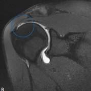 회전근개건병증 Rotator Cuff Tendinopathy Overuse Apoptosis Tendinosis 단백질키나아제활성화콜라겐합성저하, 기질재형성저하시간의경과