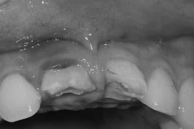 (2) 두께가두꺼운치주조직 (Thick, flat periodontium) 연조직의외형이평평하고, 많은양의부착조직을가지는치밀한섬유성연조직을가지는경우이며, 흡수에저항하는두꺼운골형태를가지고있고, 치아의형태는일반적으로사각형의외형이다. 섬유성인연조직특성으로인해판막을거상할때절개선에반흔조직이발생하여비심미적으로나타날수있다.