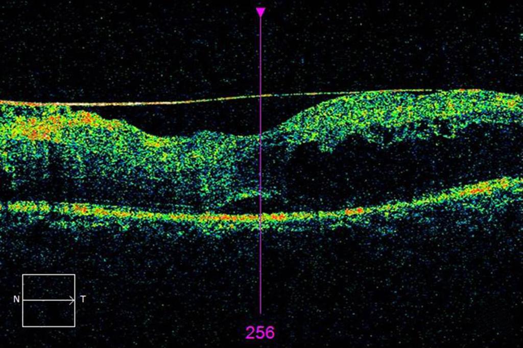 It shows that the retina and the ERM have a wide area of contact in (A).