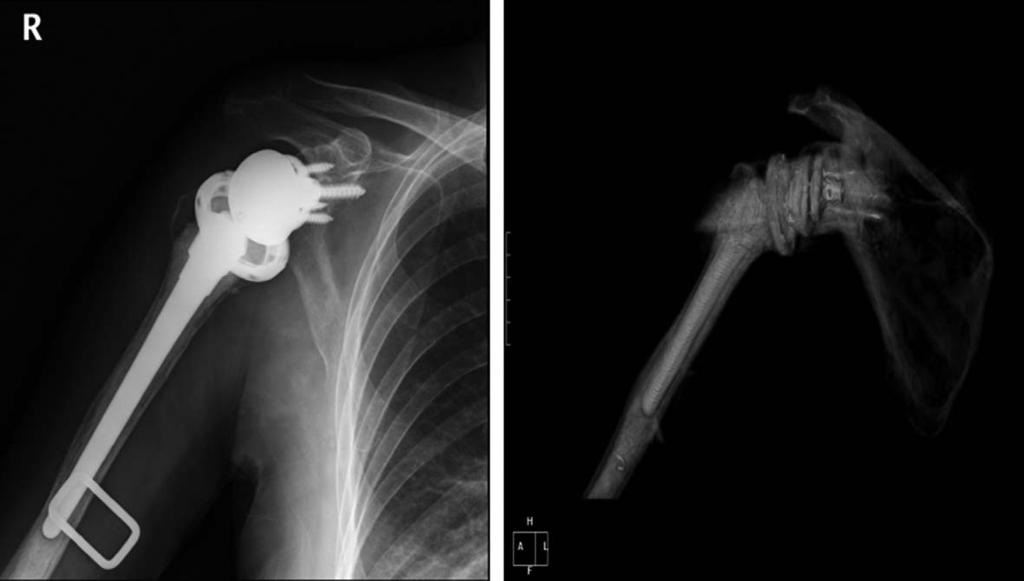 대한견 주관절학회지제 14 권제 1 호 Fig. 7. Plain radiograph () and 3-dimensional reconstruction CT () of the cemented reverse total shoulder arthroplasty (iomet comprehensive reverse system). 7. 시험정복 (Trial reduction) 8.