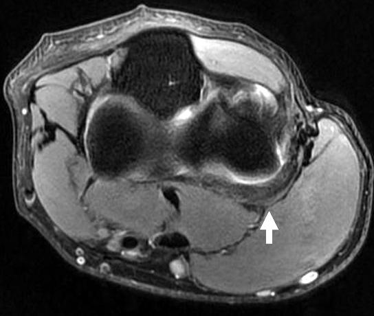 365 Snapping Elbow Caused by the Plica on Ultrasonography 단순방사선검사상전후사진, 측면사진에서정상소견을보였고, MRI상에서요골상완골관절전방에저신호강도의띠가관찰되었다 (Fig. 1).