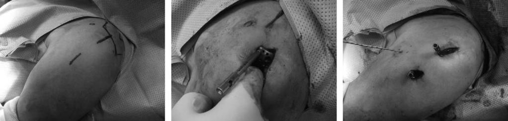 대한견 주관절학회지제 13 권제 2 호 A B C Fig. 1. MIPO technique. (A) Proximal skin incision is made from the anterolateral tip of the acromion extending approximately 4 cm distally.