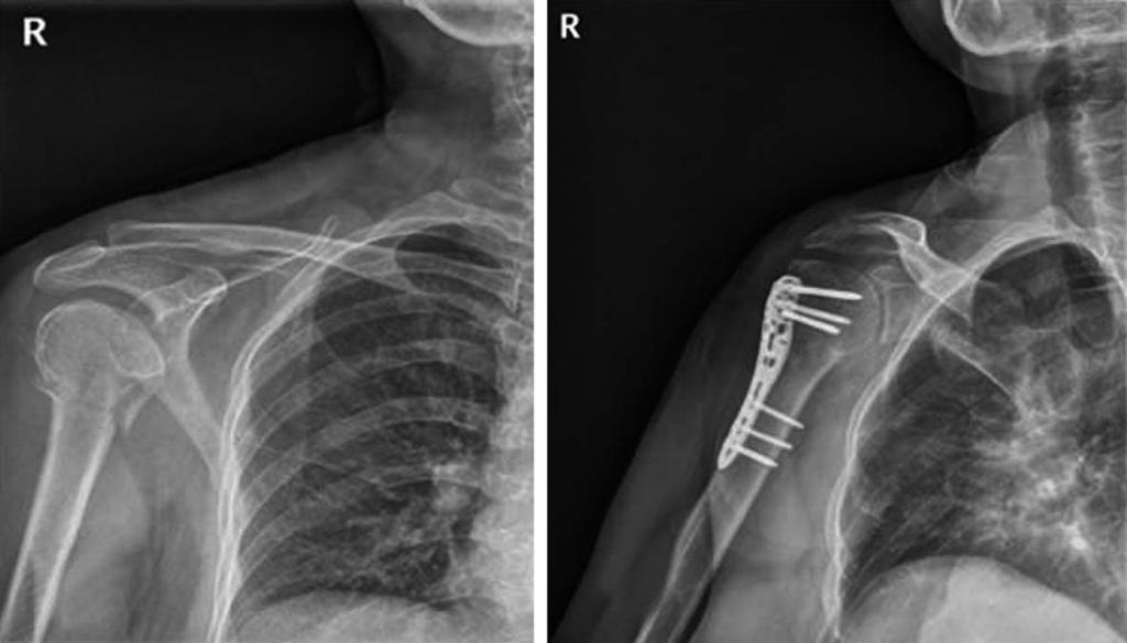 (B) Insertion of plate through deltoid splitting approach palpating the axillary nerve and protecting the axillary nerve by index finger.