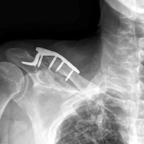 (B) The distal clavicular fracture was stabilized with the Hk plate.