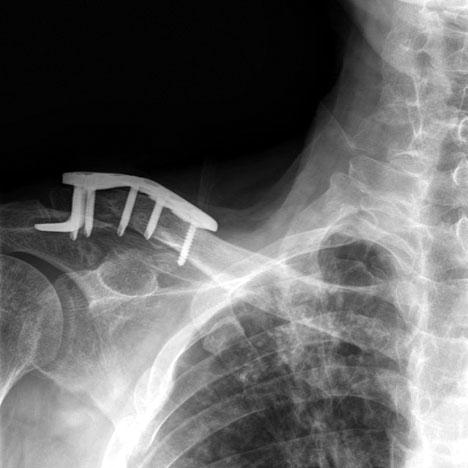 (A) Neer type IIa fracture f clavicle in a 39-year-ld man.