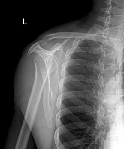 (A) Shoulder true AP shows a fracture of proximal portion of coracoid process, and (B) lateral view shows fracture of proximal acromion and