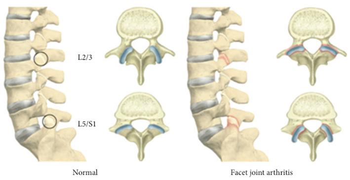 Fig. 5. FJ arthritis and FJ orientation. On the left side, sagittally oriented FJs at L2/3 and coronally oriented FJ at L5/S1 are associated with normal FJs at the lumbar spine.