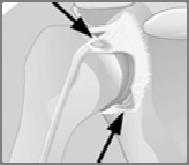 관절와순손상 Glenoid Labrum Injury SLAP 병변 ( 상부관절와순전후병변 ) Superior Labrum from Anterior to