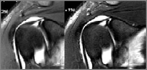 상부관절와순전후병변 SLAP lesion Type III Konkuk Univeristy Hospital Shoulder, Elbow & Sports Service