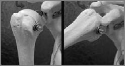 1. 충돌 Impingement 2. 회전근개손상 Rotator Cuff Injury 3. 관절와순손상 Glenoid Labrum Injury 4. 관절와상완관절탈구 Dislocation of Glenohumeral Joint 5.