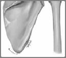 이차적외적충돌 Secondary External Impingement 원인 Periscapular muslces : Imbalance Antero-Inferior translation of Acromion Deltoid vs Rotator