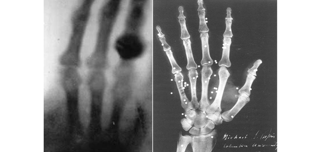 102 채종서 Fig. 1. X-ray photo by W. Roentgen in 1895 (left) High resolutive X-ray photo at New York hospital in 1896 (right). 영상시장도분자영상의학시장확대에따라의료용가속기수요가증대되고있다.