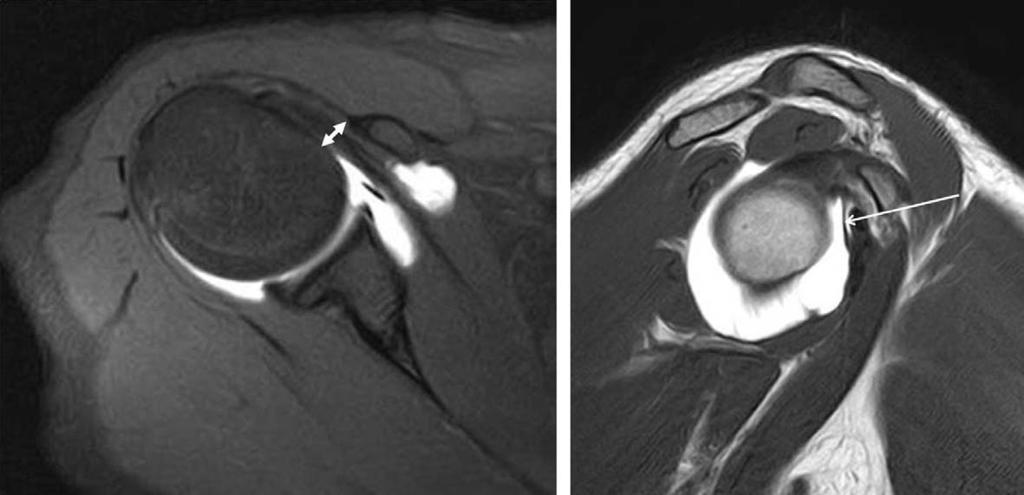 오구충돌증후군은그빈도나유병율이아직세계적으로도밝혀지지않은드문질환이다 7). 견갑하근이견 Fig. 1. Preoperative MRI shows subacromial bursitis and intact biceps pulley.
