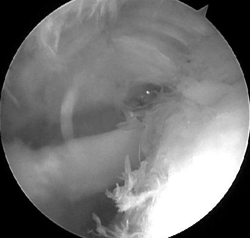 되었으나개방성접근과관절경하접근이모두쉽지않았던견봉 쇄골관절아래의내측부에서일부남아있는소견이관찰되었다 (Fig. 5). 고찰 Figure 4.