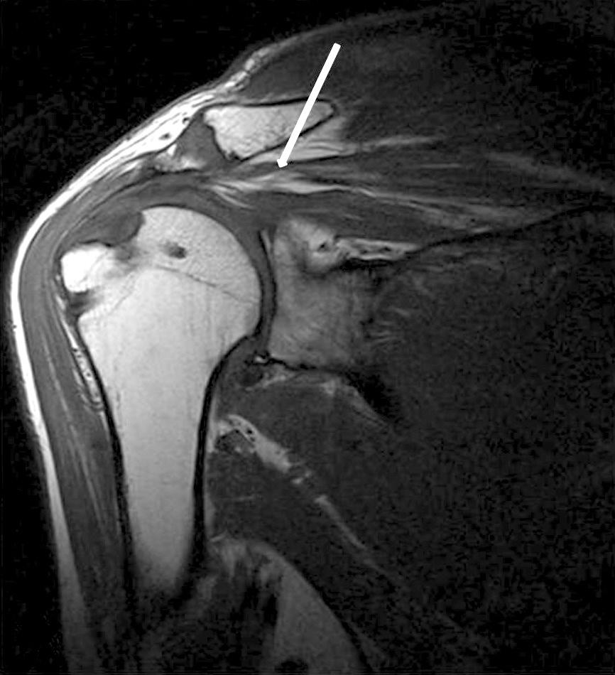 (C) Follow-up MRI (postoperative one-year later) coronal section shows that rotator cuff was repaired. 상견갑신경하방분지의마비를보고한바있으나근육내지방종은아니었다.