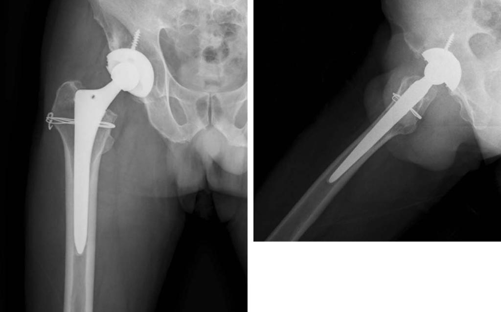 B A Fig. 4. Anteroposterior (A) and lateral (B) radiographs showing circlage wires around proximal femur for intraoperative fracture. 고 찰 Fig. 5.