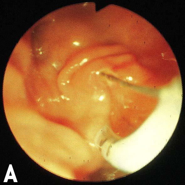 - The Korean Journal of Medicine: Vol. 75, No. 6, 2008 - A B Figure 1. (A) Before endoscopic sphincterotomy. The sphincterotome was inserted into the common bile duct.