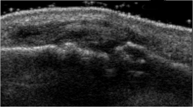 (hyperechoic pattern) or both (mixed pattern), may exhibit Doppler signal Focal or diffuse thickening of the tendon, loss of fibrillar echotexture and patchy