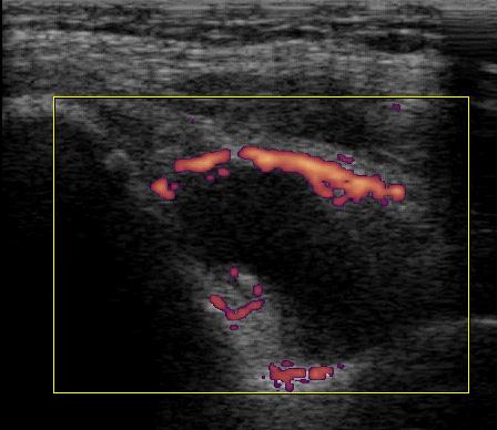() Enlargement of the joint space due to joint effusion. () Power Doppler showing increased synovial perfusion in early rheumatoid arthritis.