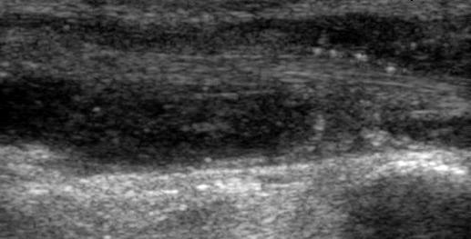 - The Korean Journal of Medicine: Vol. 78, No. 6, 2010 - extensor digitorum tendon extensor digitorum tendon Figure 3. Tenosynovitis.