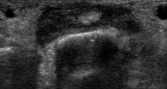 In addition, nonhomogeneous or hyperechoic materials due to synovial hyperplasia are seen (yellow arrow). () Transverse scan showing hypoechoic halo around the tendon (arrows).