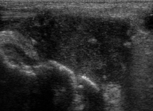 () Gray-scale ultrasonography showing effusion (red arrow), synovial proliferation (yellow arrow), and bone erosion (blue arrow) of the ankle joint.