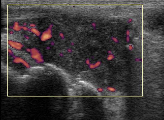 Doppler semi-quantitative grading system Grade 0 No Doppler signal (color pixel)/no flow Grade 1 Single Doppler signal/little flow (three single spots or two single spots plus one confluent spot)