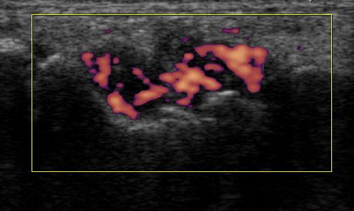 정중신경 (median nerve) 은손목부위에서고에코성을보이는굴근지대 (flexor retinaculum) 아래를통과하는데정상적으로타원형이고원위부로주행할수록보다납작한모양으로변한다. 정중신경이수근관내에서압박되면수근관입구 (inlet) 근위부부분이팽창하여이부위의두께가증가하고저에코성을보이며, 굴근지대가위쪽으로돌출되고수근관내의정중신경은보다편평한모양으로변한다.