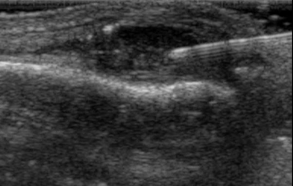 - 대한내과학회지 : 제 78 권제 6 호통권제 598 호 2010 - Figure 6. Ultrasound-guided procedures. () ccurate needle (arrow) positioning to aspirate fluid or inject steroid can be guided and monitored.