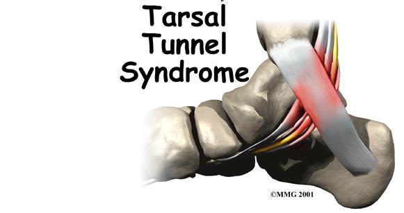 6. 정강신경손상 (Tibial Nerve Injuries) 원인 - tarsal tunnel 손상 ( 발목외상, 염좌등 ) - severe fracture of distal femur & proximal tibia - soft tissue injury of posterior knee - 발목굴증후군 ( 발목굽힘근지지띠부위압박 ) - 기능장애 :