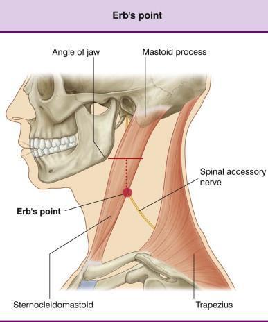 3. Klumpke's Paralysis( 크롬프케마비 ) : Lower arm type : C8~T1 C8 nerve root injury 의임상적증상 (Grasp reflex 의결핍 ) 1 Motor defects - long thumb
