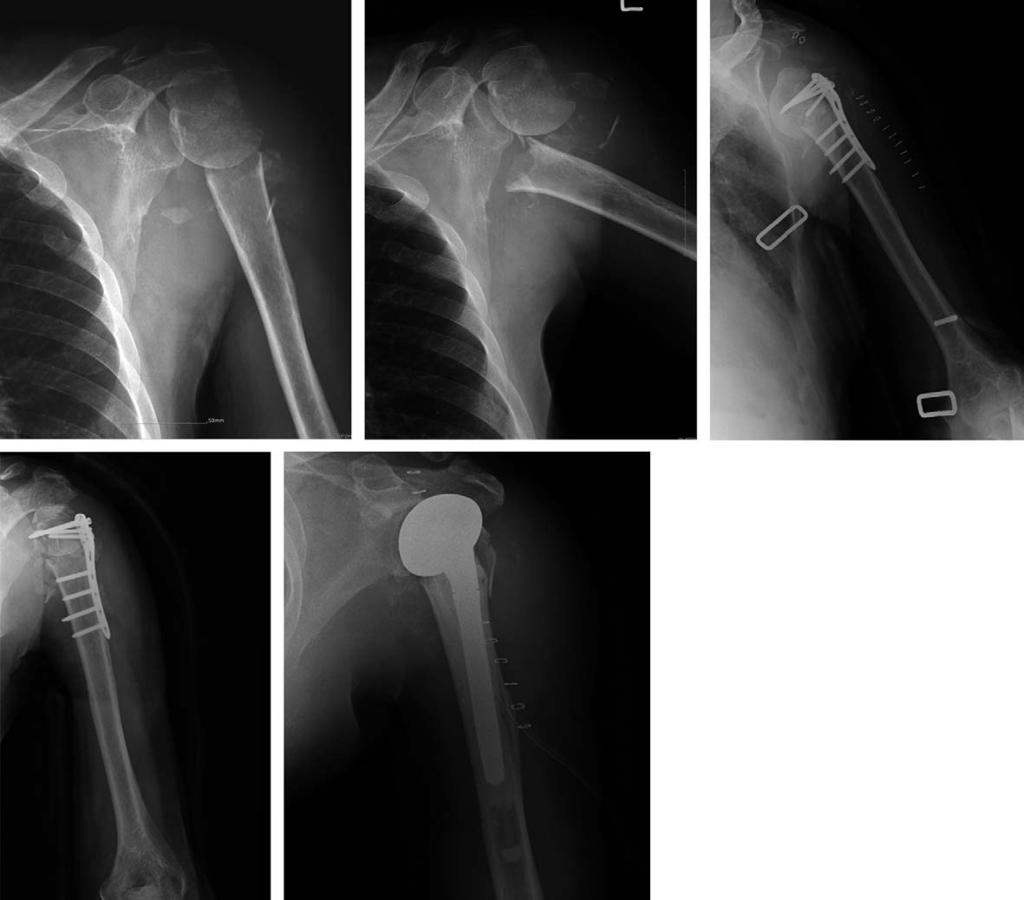 대한견 주관절학회지제 14 권제 1 호 A B C Fig. 3. 71 year old man with two fracture and C3 fracture. (A) Preoperative radiograph. (B) 90 varus and severe displaced fracture.