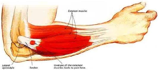 Long extensors 위팔노근 (brachioradialis) O. 가쪽관절융기위능선의몸쪽 2/3, 가쪽근육사이막 I. 노뼈붓돌기바닥의가쪽면 A. 위팔두갈래근과위팔근에의해굽힘이일어난이후아래팔을굽힘, 약간의엎침과뒤침 N.