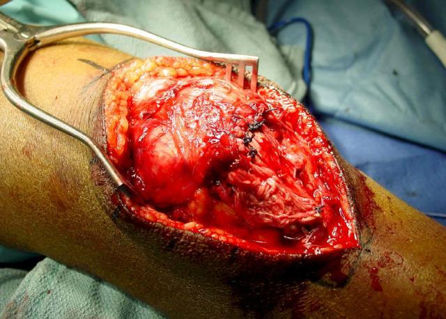 힘줄손상의호발부위 Achilles tendon) ligamentum patellae tendon Hamstring tendon rotator cuff tendon (