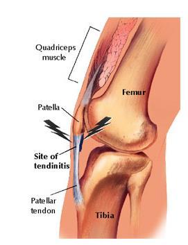 flexor tendon-(golfer's elbow) extensor pollicis longus tendon abductor pollicis longus tendon